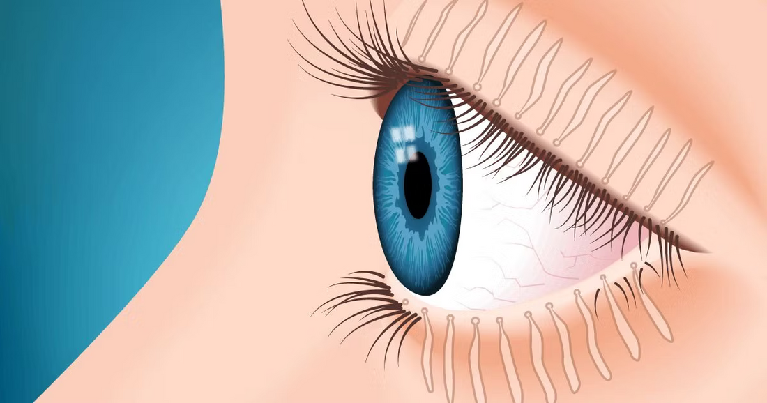 blocked meibomian glands causing dry eye disease